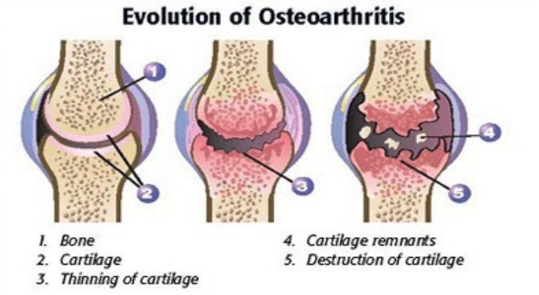 evolution-of-osteoarthritis